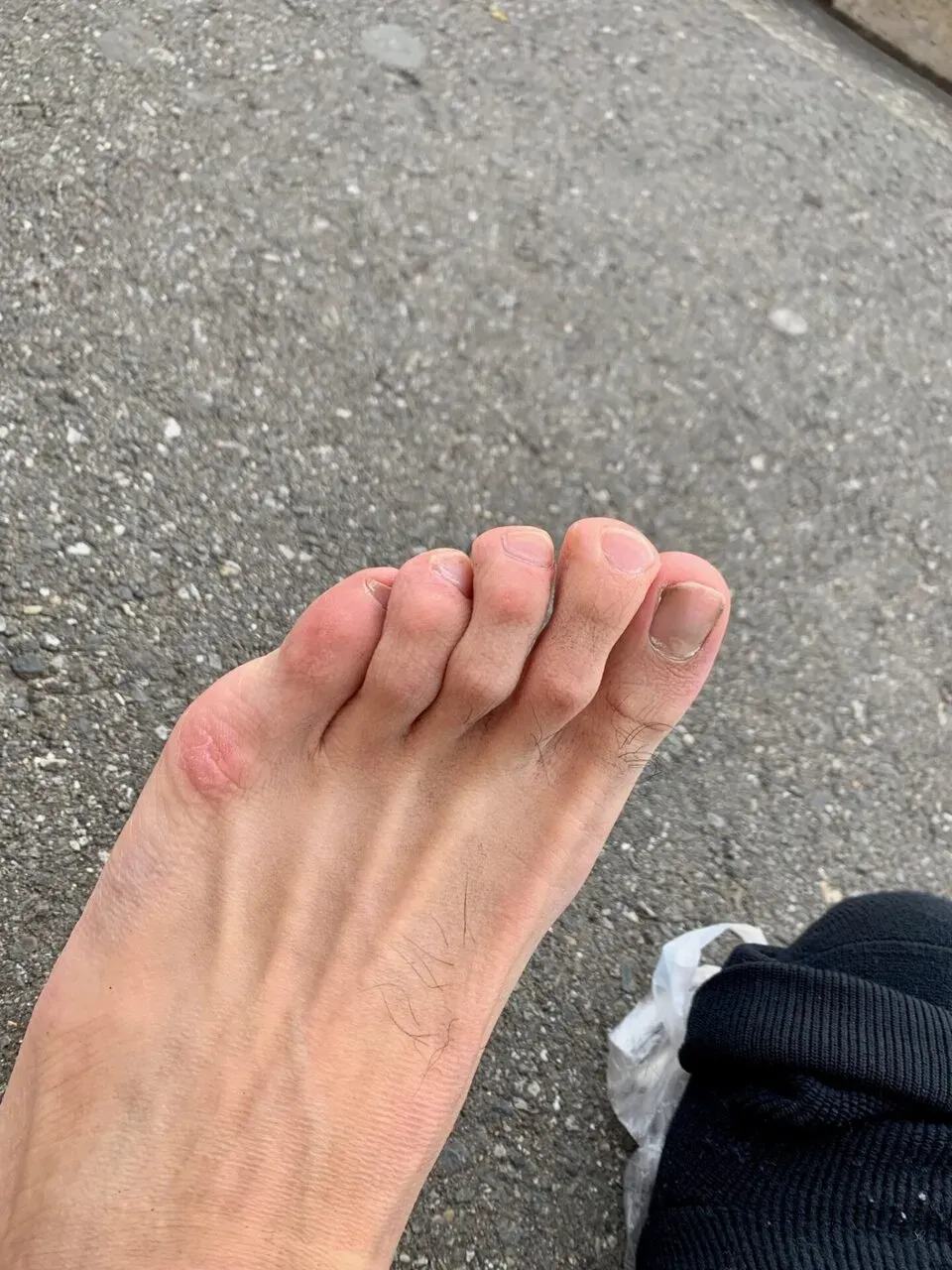 つま先や間接が痛いので確認。若干赤い。