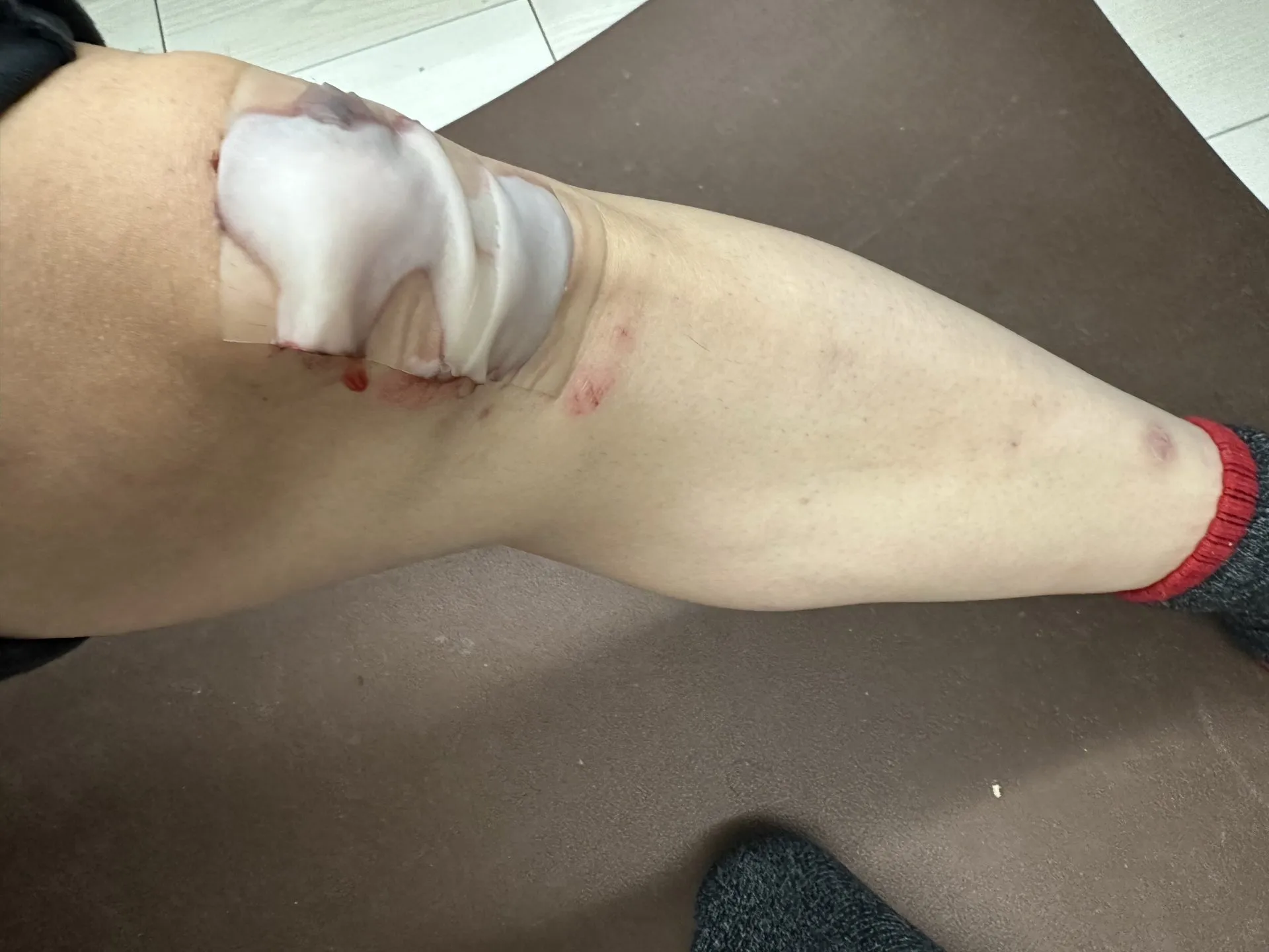 擦り傷に”エアウォール”が良い!キズパワーパッドの1/7ぐらいのコスト - 画像7