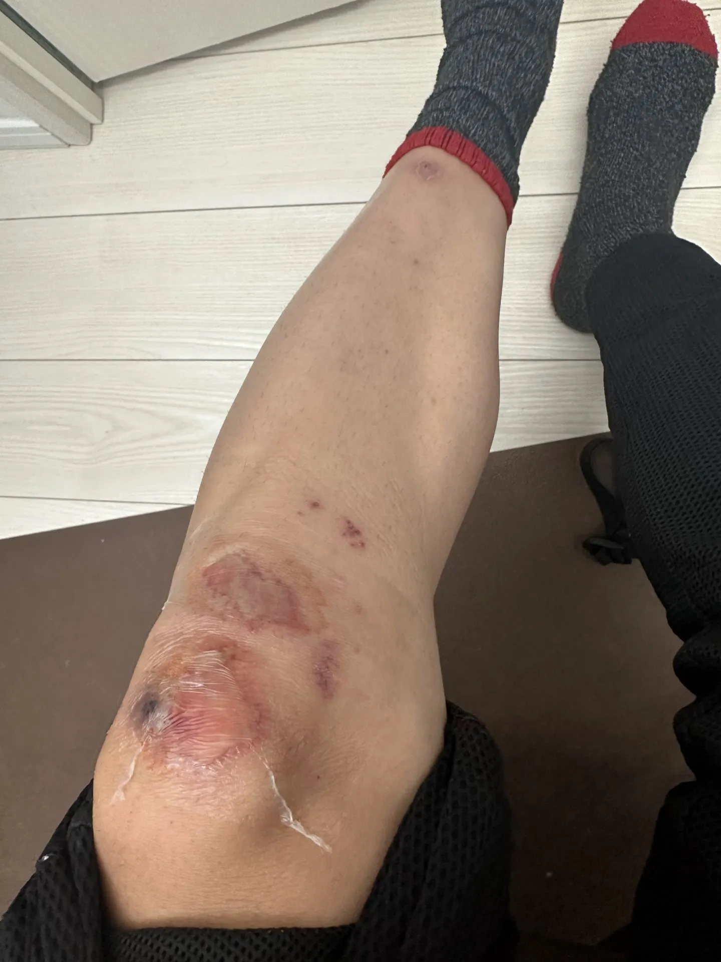 擦り傷に”エアウォール”が良い!キズパワーパッドの1/7ぐらいのコスト - 画像8