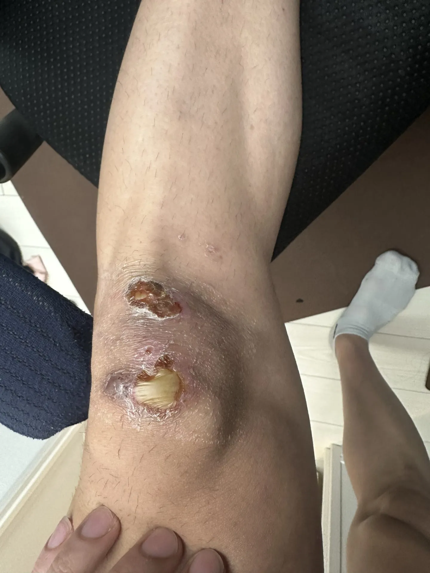 擦り傷に”エアウォール”が良い!キズパワーパッドの1/7ぐらいのコスト - 画像9