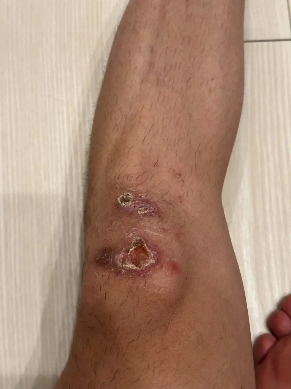 擦り傷に”エアウォール”が良い！キズパワーパッドの1/7ぐらいのコスト - 画像10