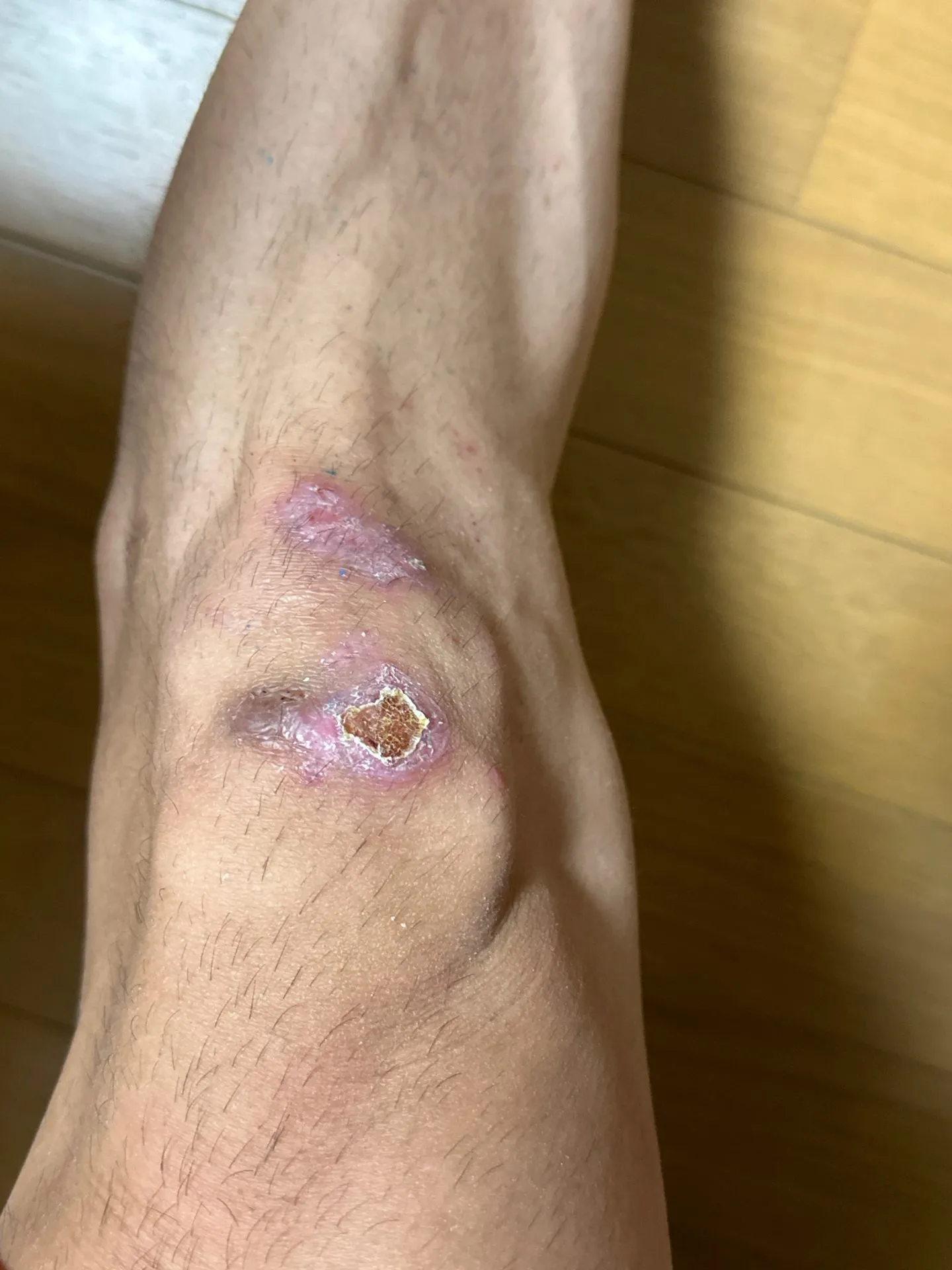 擦り傷に”エアウォール”が良い!キズパワーパッドの1/7ぐらいのコスト - 画像11