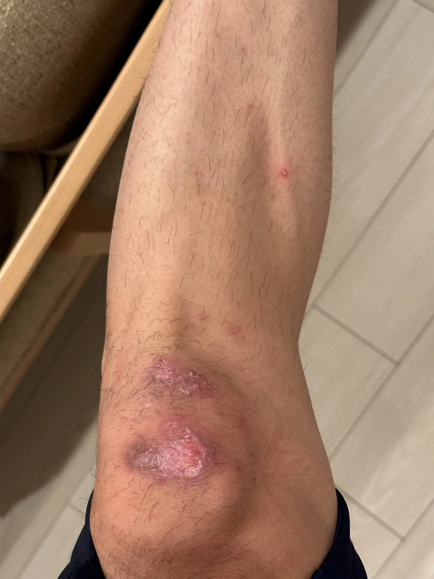 擦り傷に”エアウォール”が良い!キズパワーパッドの1/7ぐらいのコスト - 画像12